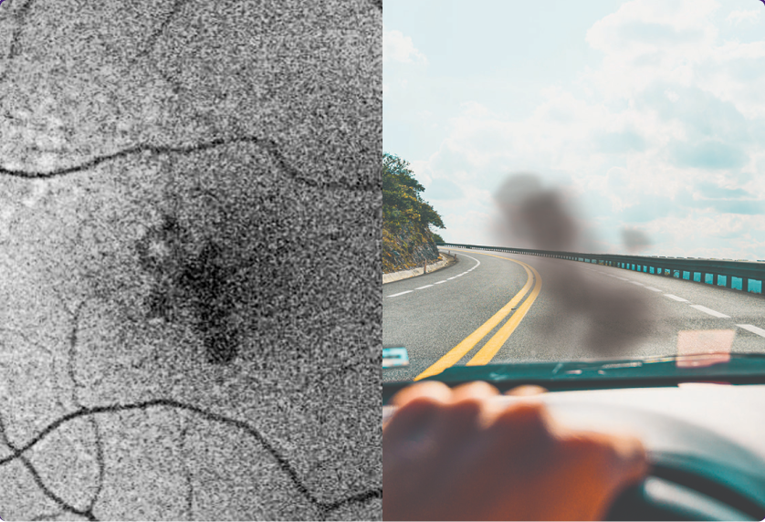 What may happen to your retina_1, What you may see_1