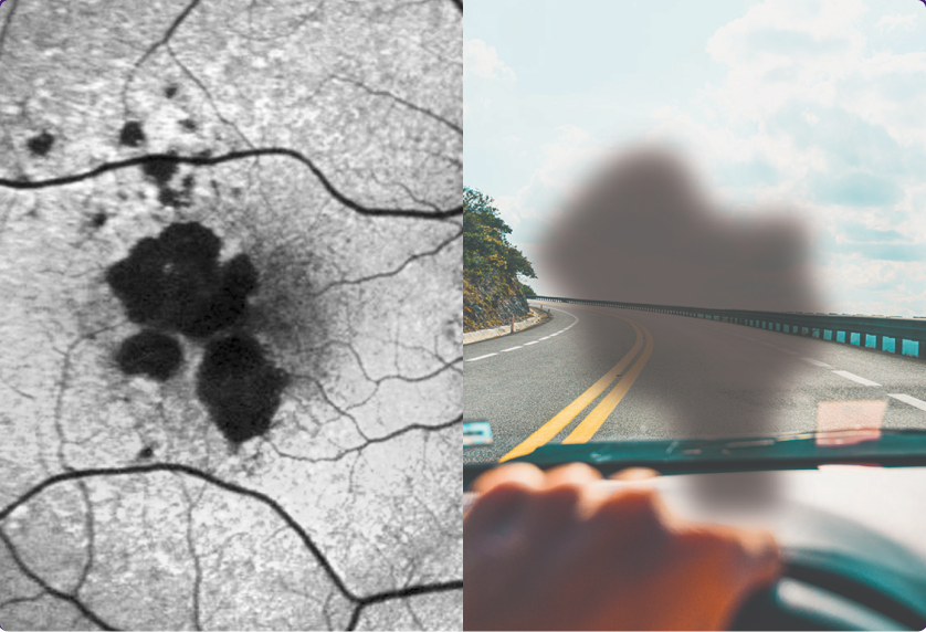 What may happen to your retina_2, What you may see_2