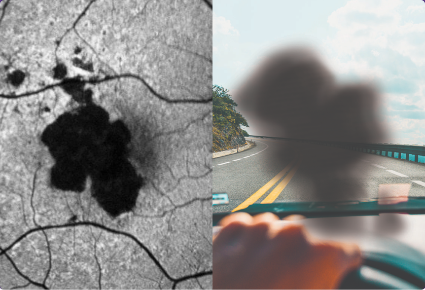 What may happen to your retina_3, What you may see_3